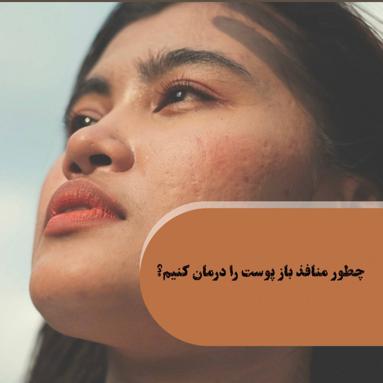 درمان منافذ باز پوست